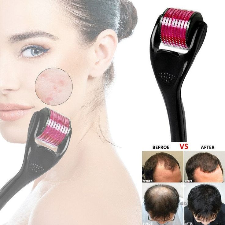 Derma Roller for Hair Growth And Acne Removal